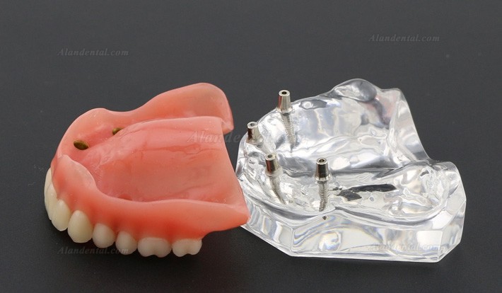 Dental Study Teeth Model Overdenture Superior With 4 Implants Demo Model 6001